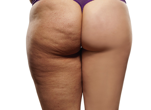 tratamiento de celulitis